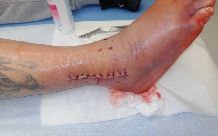 Zszyta stopa po operacji, z widocznymi szwami.