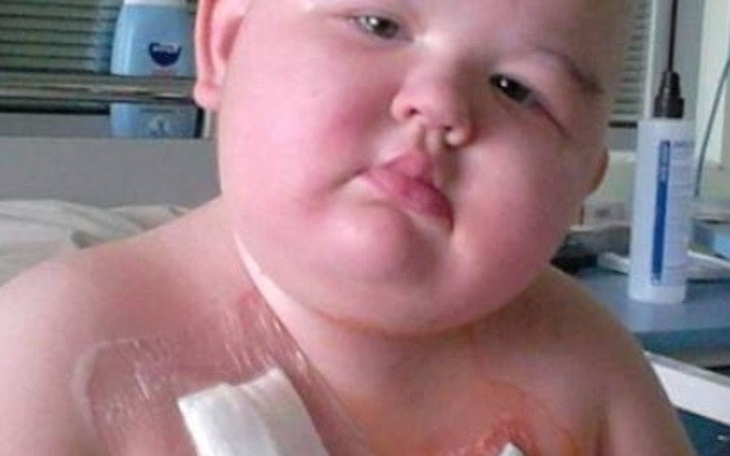 Dziecko z bandażem na klatce piersiowej, patrzące w obiektyw.