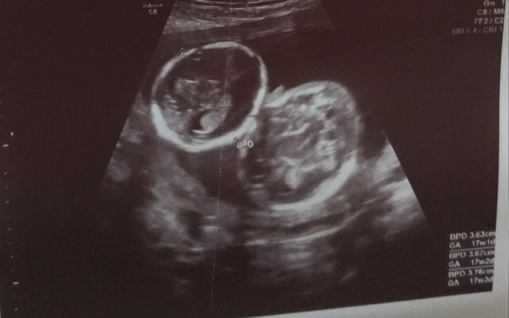 Zbiórka Wyprawka dla bliźniąt - zdjęcie główne