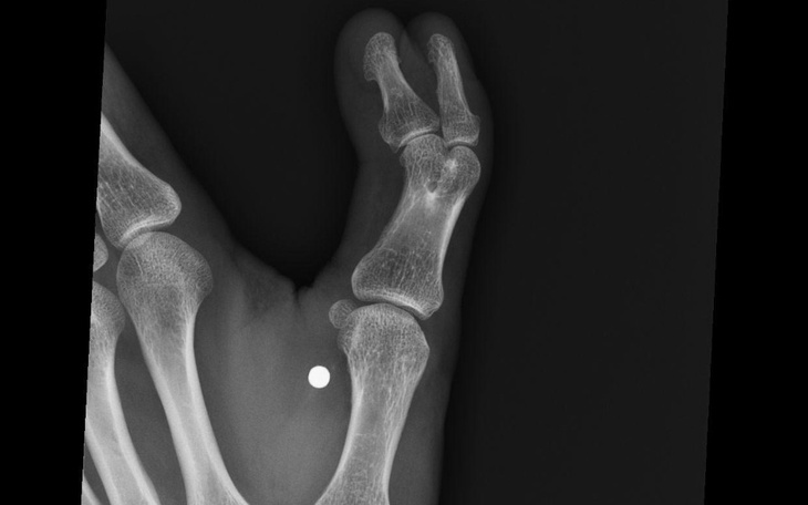 Rentgen ręki, ukazujący szczegóły kości.