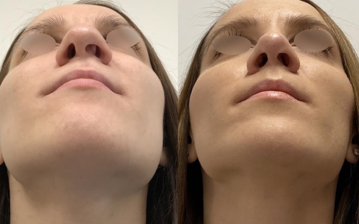 Zbiórka Rynoplastyka Nosa - zdjęcie główne