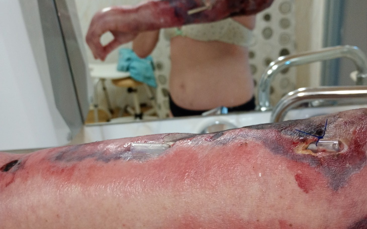 Zdjęcie rany na ramieniu, z widocznymi szwami.