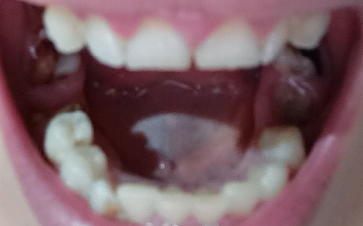 Zbiórka Na nowe zęby. Pomocy - zdjęcie główne