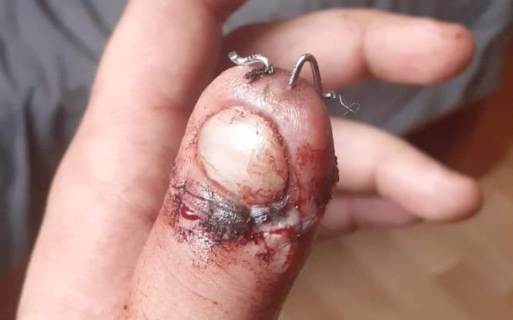 Zbiórka Rehabilitacja palców po wypadku - zdjęcie główne