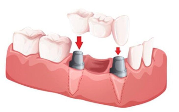 Zbiórka Implanty dla taty - zdjęcie główne