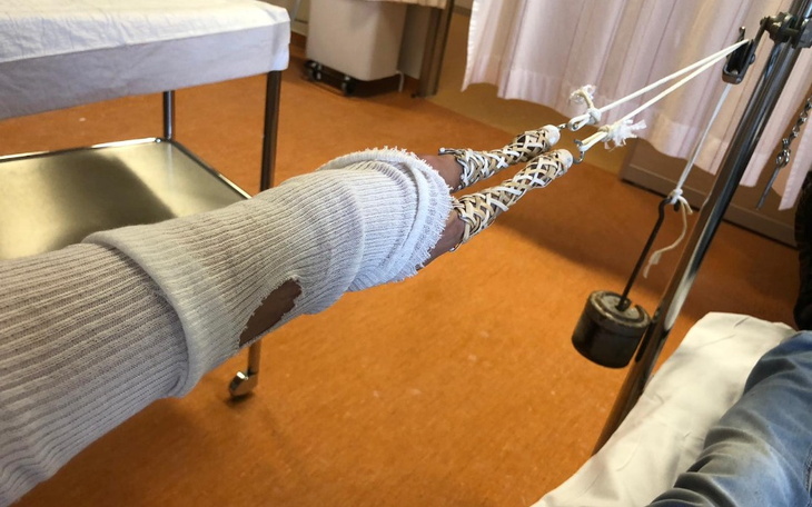 Ręka w bandażach, z widocznymi uszkodzeniami.