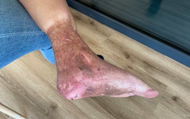 Uszkodzona ręka po oparzeniach.