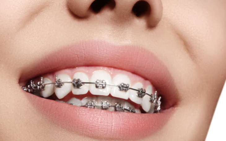 Zbiórka Ala Nowak, aparat na zęby - zdjęcie główne