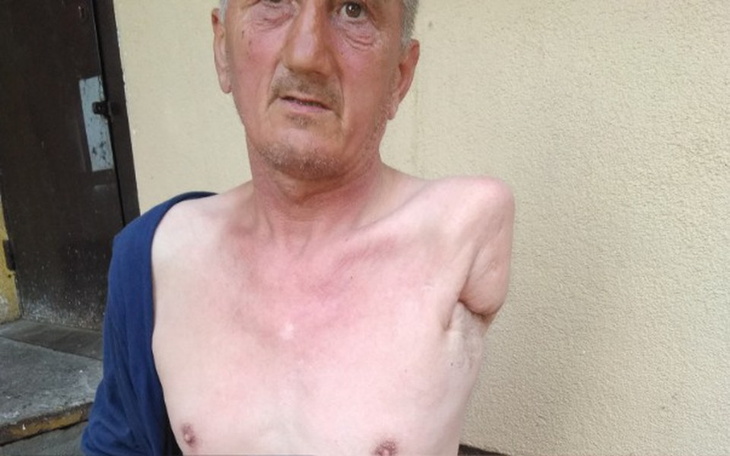 Zbiórka Zbiorka na proteze ręki - zdjęcie główne