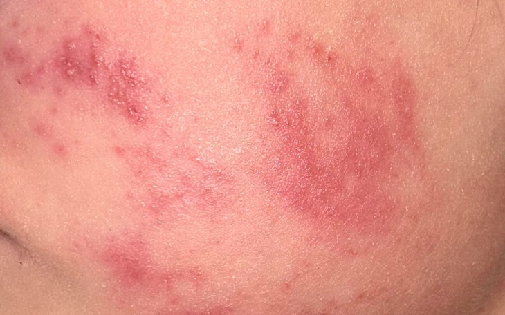 Zbiórka Zbiórka na leczenie AZS - zdjęcie główne