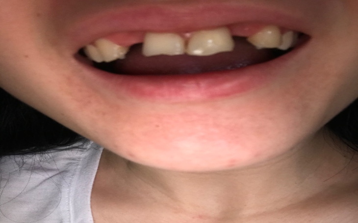 Zbiórka Na implant zębów - zdjęcie główne