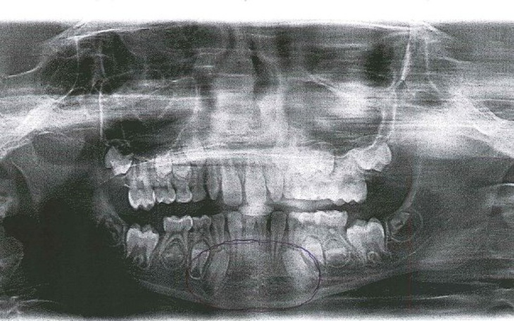 Zbiórka uzupełnienie uzębienia córki - zdjęcie główne