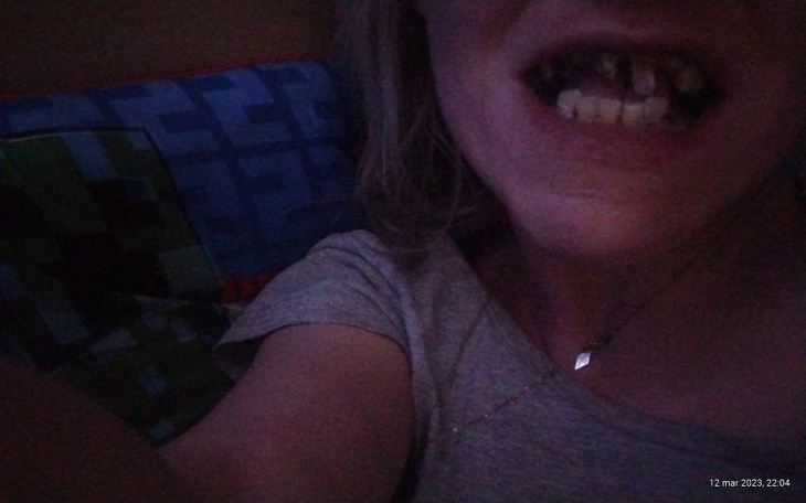 Zbiórka Zeby all on 4 - zdjęcie główne