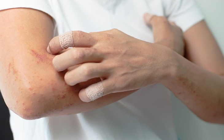 Zbiórka Leczenie uczulenia! - zdjęcie główne