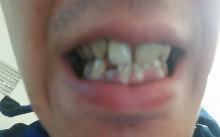 Zbiórka ratowanie zębów - zdjęcie główne