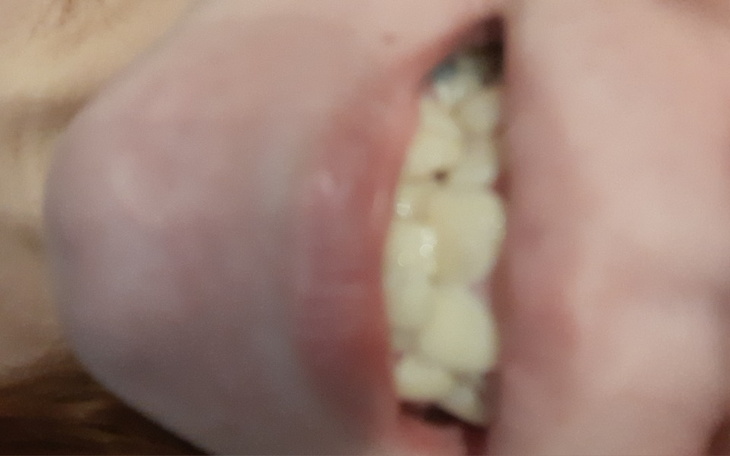 Zbliżenie na usta z widocznymi zębami.