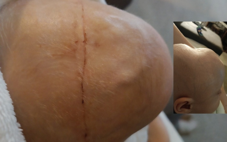Zbliżenie na głowę dziecka z widoczną blizną po operacji.