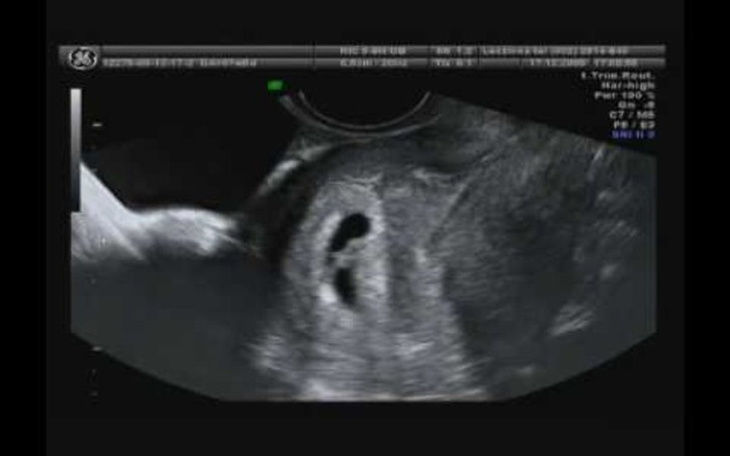 Zbiórka Sztuczne zapłodnienie - zdjęcie główne