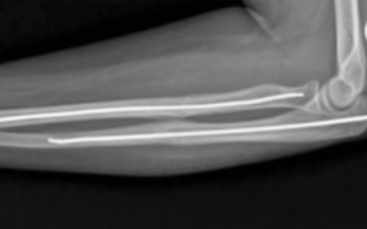 Zbiórka Na rehabilitację rozruch łokcia - zdjęcie główne