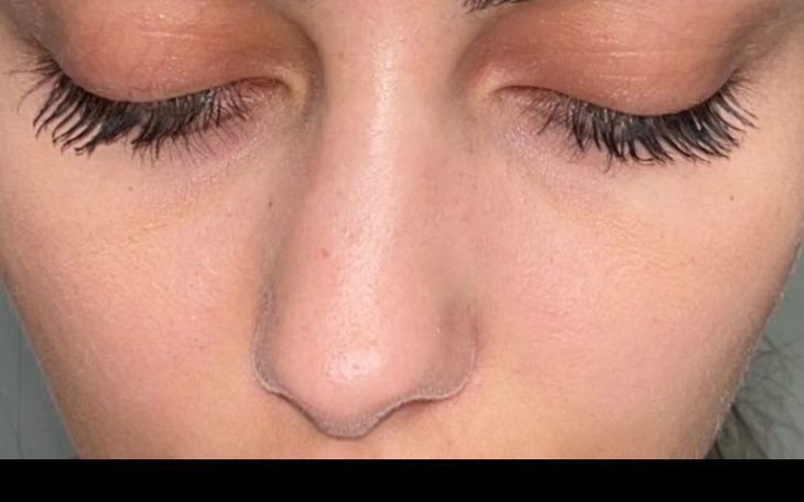 Zbiórka Operacja przegrody nosa oddech - zdjęcie główne