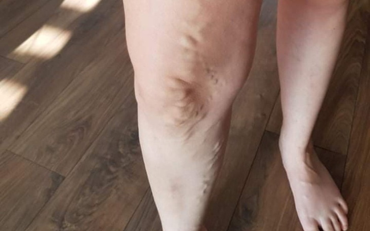 Zbiórka Zbiórka na operację żylaków - zdjęcie główne