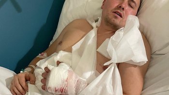 Zbiórka Pomóżmy ocalić dłoń Jacka! - miniaturka zdjęcia