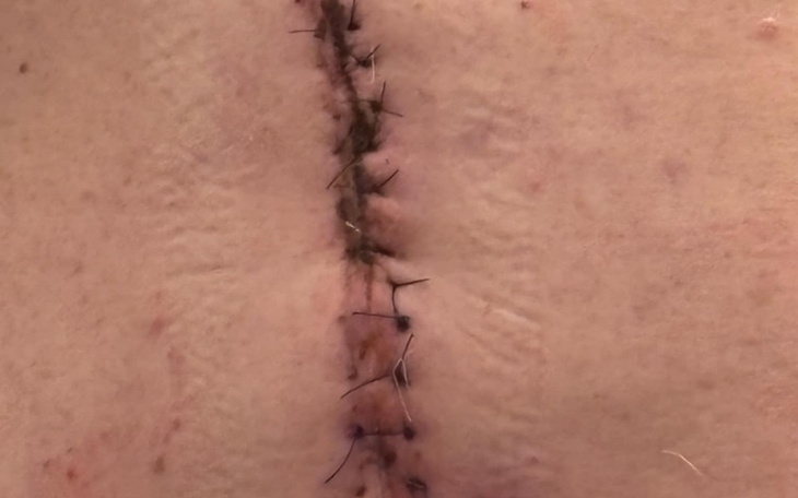 Blizna na skórze, świadcząca o przebytej operacji.