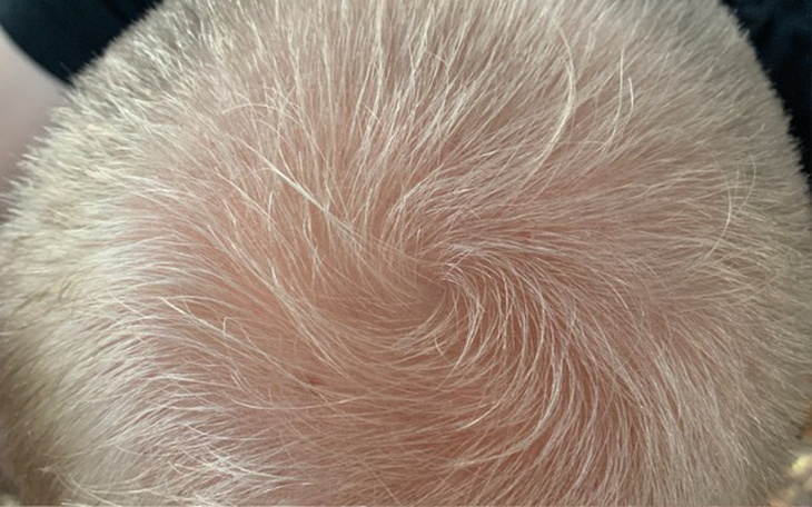 Zbiórka Przeszczep włosów dla Łukasza - zdjęcie główne