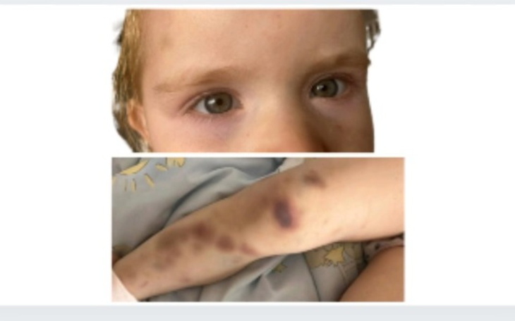 Dziecko z siniakami na twarzy i ręce, w szpitalnym łóżku.