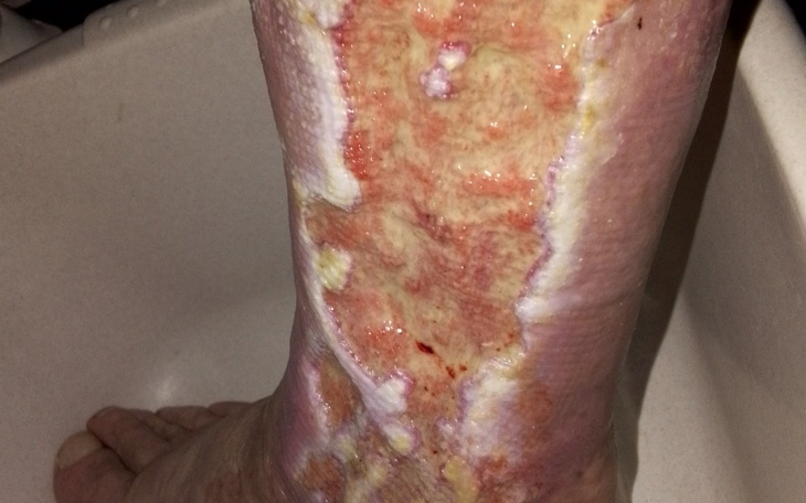 Zbiórka Zbiórka na leczenie chorej nogi - zdjęcie główne