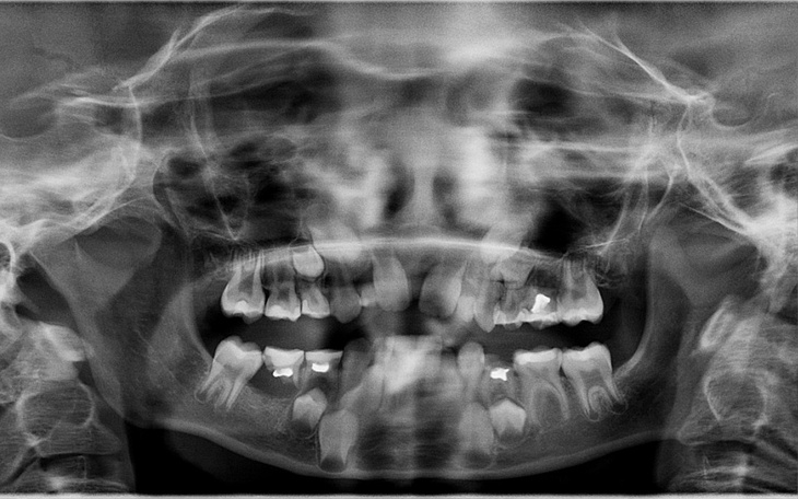 Zbiórka Oligodoncja zęby dla 9 latki - zdjęcie główne