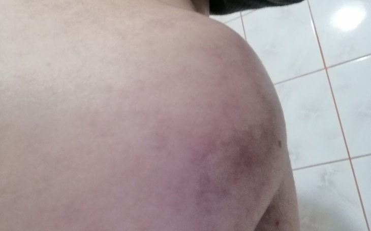 Zbiórka Operacja przepukliny laparoskopo - zdjęcie główne