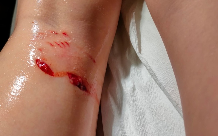 Zbiórka Leczenie nogi po ugryzieniu psa - zdjęcie główne