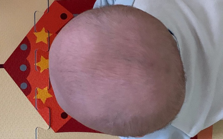 Zbiórka Kask korekcyjny dla Pawełka - zdjęcie główne