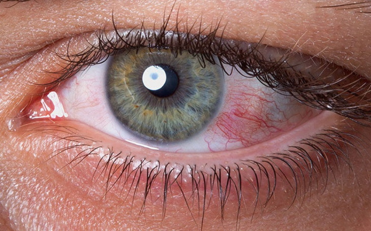 Zbiórka Leczenie zespołu suchego oka - zdjęcie główne