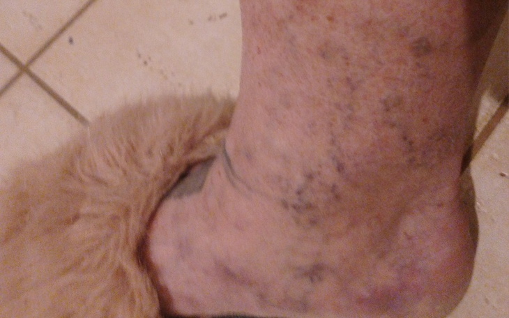 Zbiórka Operacje żylaków - zdjęcie główne