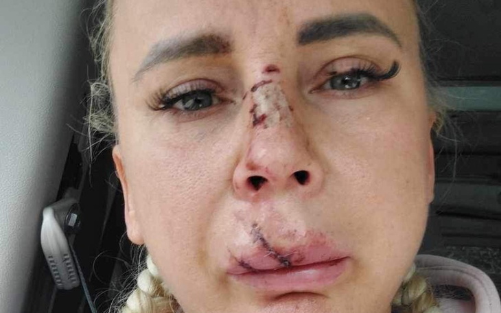 Kobieta z raną na twarzy, z widocznymi szwami.