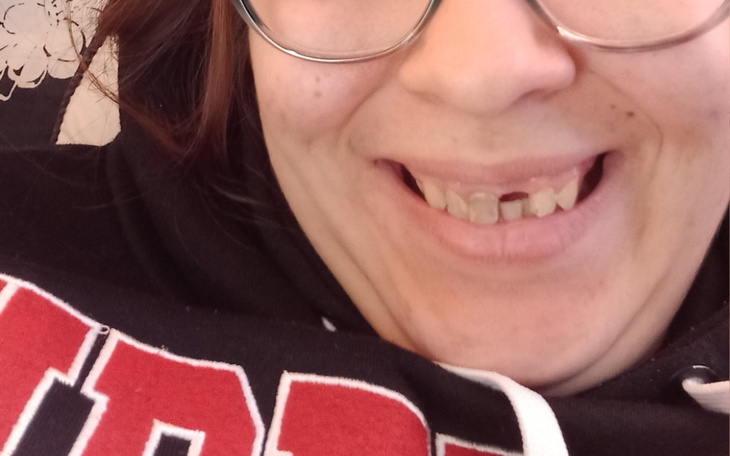 Zbiórka Na implant zębowy - zdjęcie główne