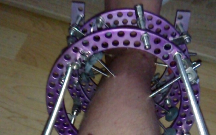 Zbiórka Ciężka rehabilitacja zagranicą - zdjęcie główne