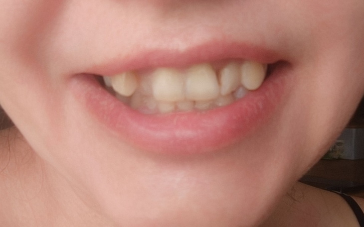 Zbiórka Na naprawę uzębienia2 - zdjęcie główne