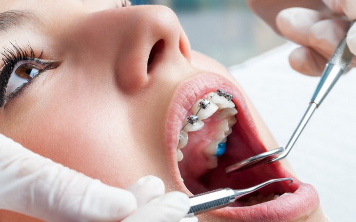 Zbiórka Stały aparat na zęby - zdjęcie główne