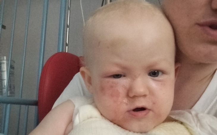 Zbiórka Rehabilitacja po oparzeniach - zdjęcie główne