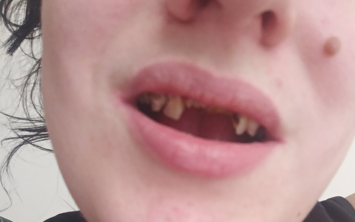 Zbliżenie na usta z brakującymi zębami, nietypowy uśmiech.