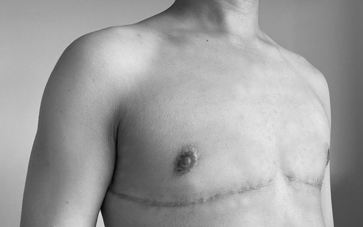 Zbiórka Mastektomia dla Eryka - zdjęcie główne