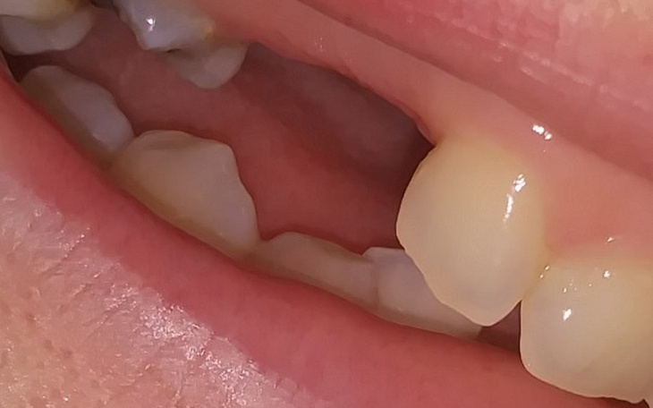 Zbiórka Na wstawienie zębów... - zdjęcie główne