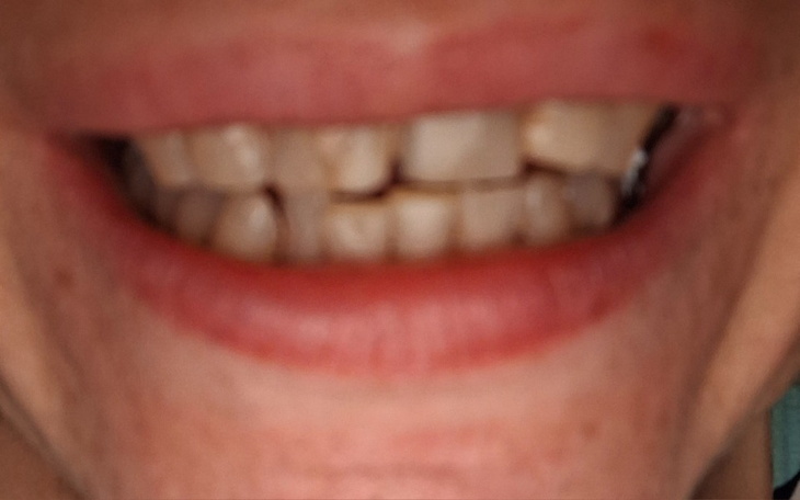 Zbliżenie na uśmiech z widocznymi zębami.