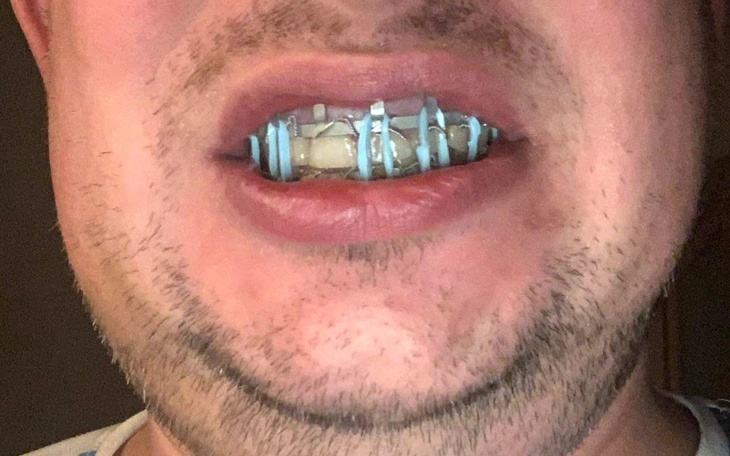 Mężczyzna z aparatem ortodontycznym na zębach.