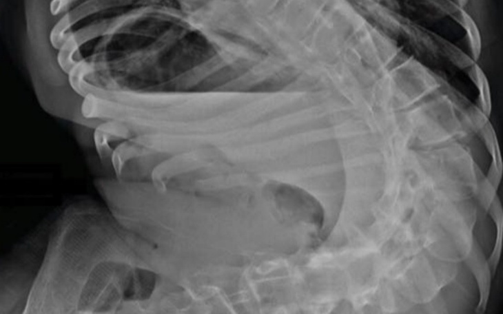 Zbiórka Operacja przepukliny kregosłupa - zdjęcie główne