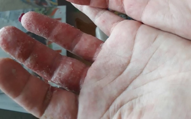 Ręka z widocznymi śladami, prawdopodobnie po pracy.