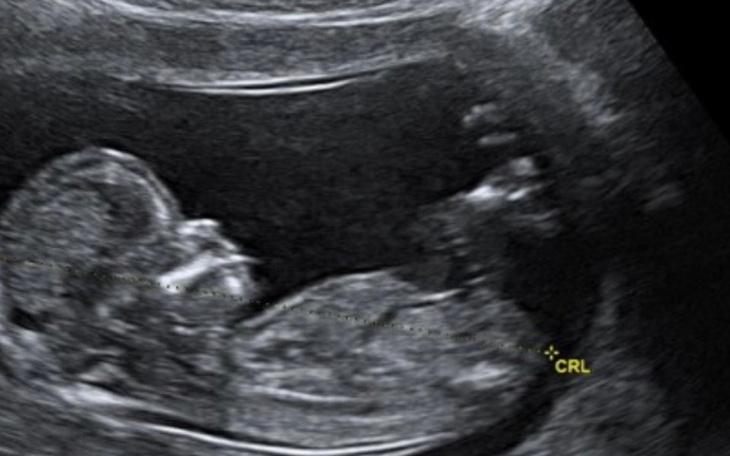 Zbiórka Poród w zaciszu domowym - zdjęcie główne